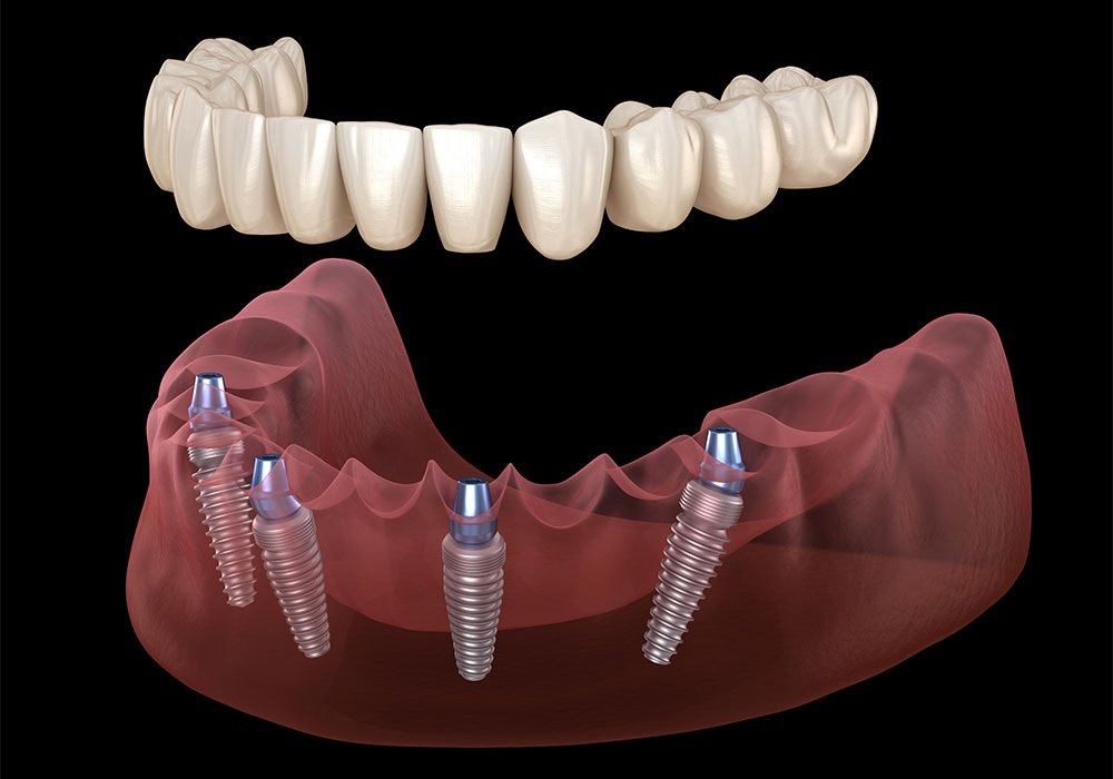 Top Dental Implant Dentist